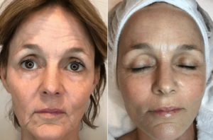 Cryo-Quantum Treatment in Oakland County MI | FACE Beauty Science