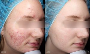 Acne Treatments in Oakland County MI | FACE Beauty Science