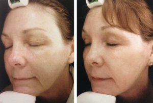 Fractional Laser Treatments in Oakland County MI | FACE Beauty Science