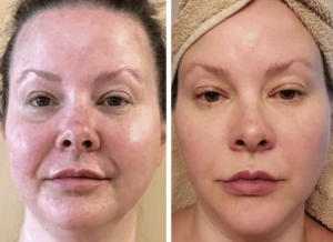 AdvaTx Laser Treatments in Oakland County MI | FACE Beauty Science