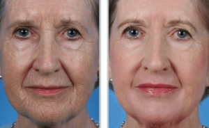 Contour TRL™ Before & After Oakland County MI | FACE Beauty Science