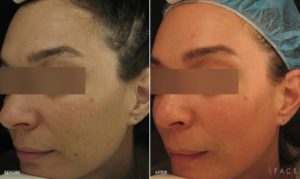 Anti-Aging Results Oakland County MI | FACE Beauty Science