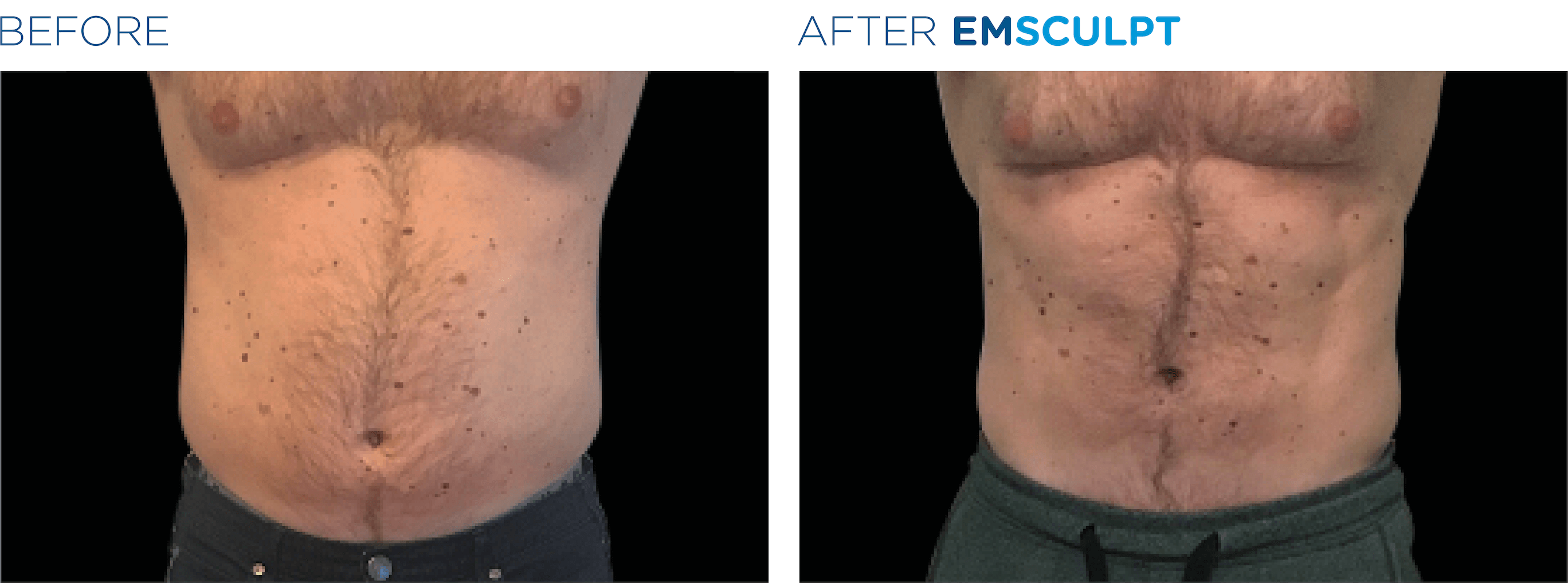 EMSCULPT® Treatments in Oakland County MI | FACE Beauty Science