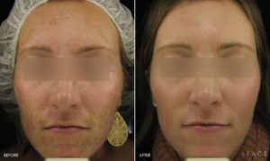 Hyperpigmentation & Melasma Treatments in Oakland County MI | FACE Beauty Science