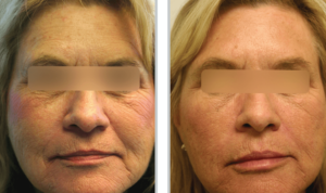 ProFractional™ Treatments in Oakland County MI | FACE Beauty Science