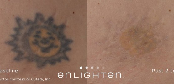 Laser Tattoo Removal Birmingham | Enlighten Laser Oakland ...