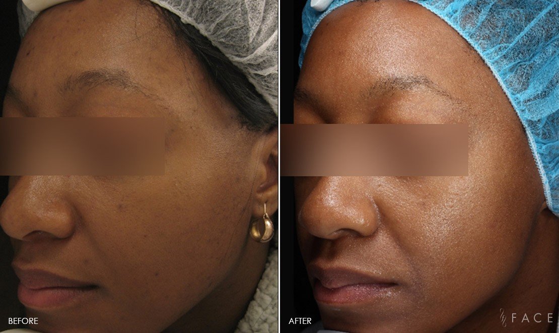 Uneven Skin Tone Birmingham Skin Texture Bloomfield Hills Face Beauty Science