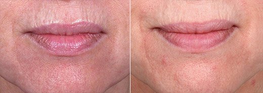 Venus VIVA™ Treatments in Oakland County MI | FACE Beauty Science