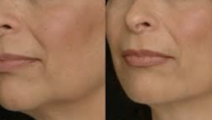 Nefertiti Neck Lift in Oakland County MI | FACE Beauty Science