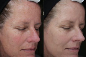 Moxi Laser Treatments in Oakland County MI | FACE Beauty Science