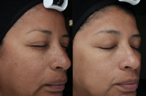 Moxi Laser Treatments in Oakland County MI | FACE Beauty Science