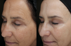 Moxi Laser Treatments in Oakland County MI | FACE Beauty Science