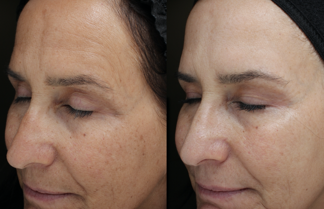 Moxi Laser Treatments in Oakland County MI | FACE Beauty Science | Face