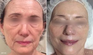 AGING AND WRINKLES Treatments in Oakland County MI | FACE Beauty Science