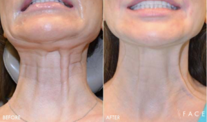 Nefertiti Neck Lift | FACE Beauty Science | Oakland County MI