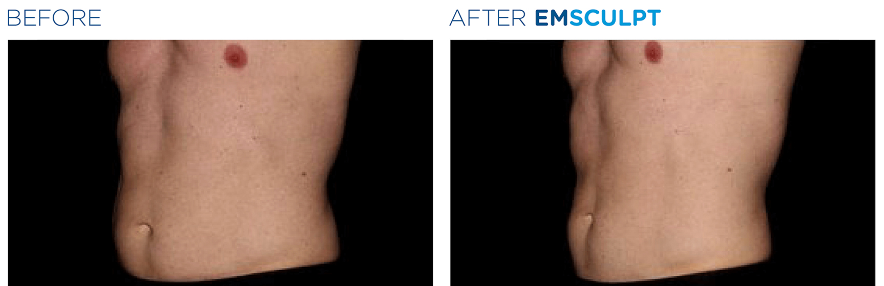 emsculpt before and after3