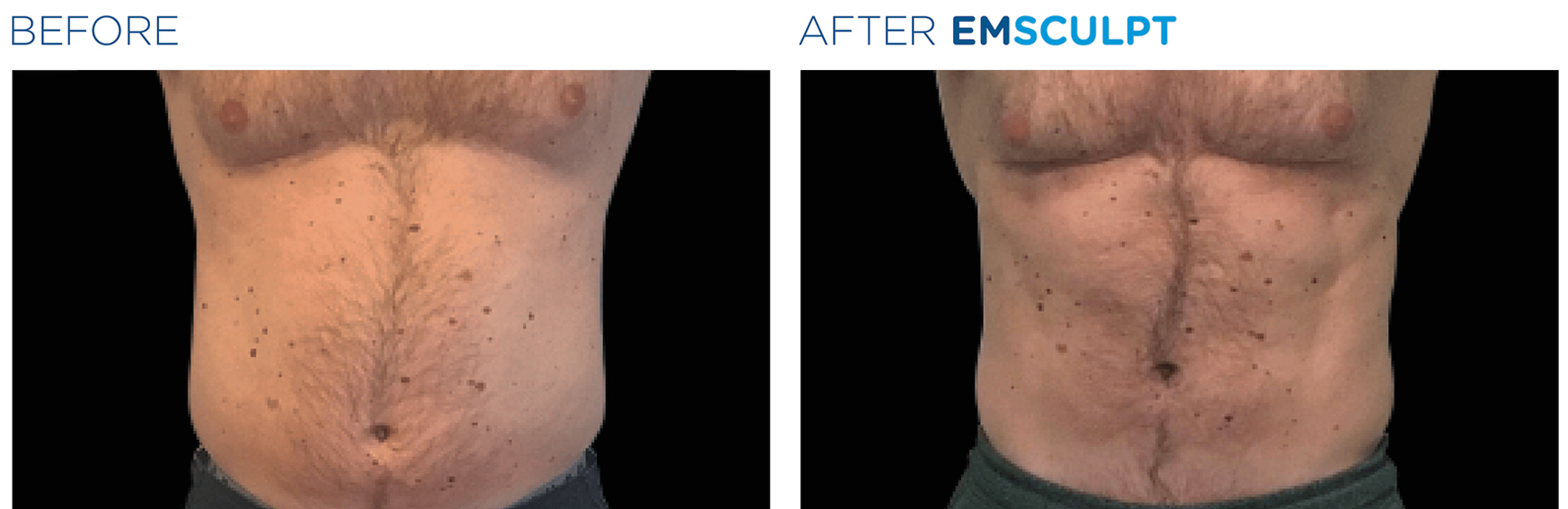 emsculpt before and after4