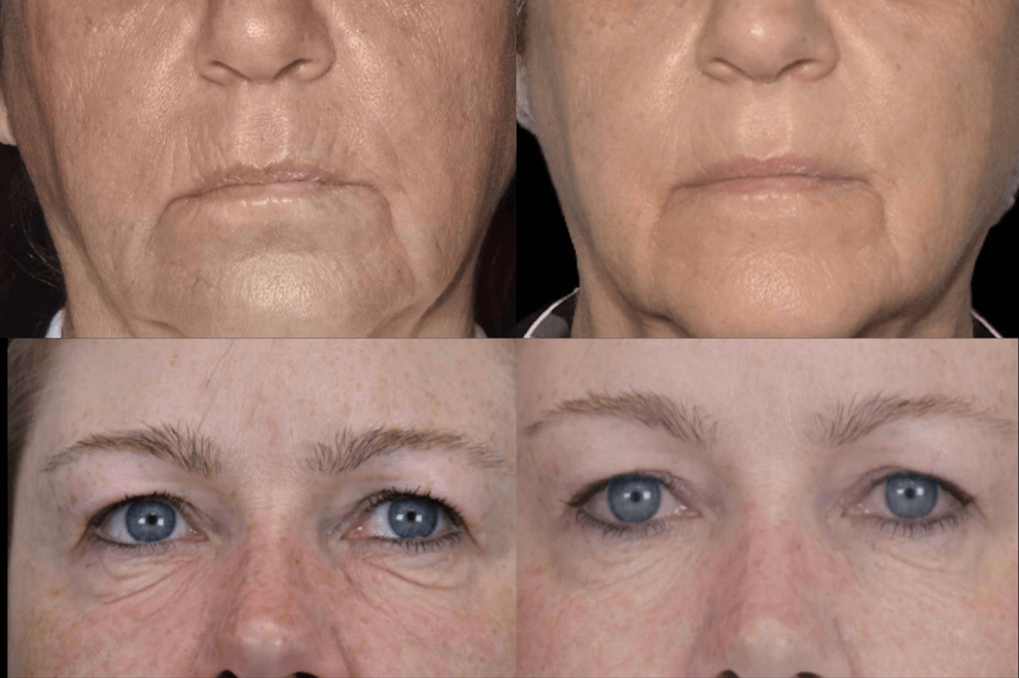 Exion Face | Before and After at FACE Medspa in Bloomfield Hills, Michigan