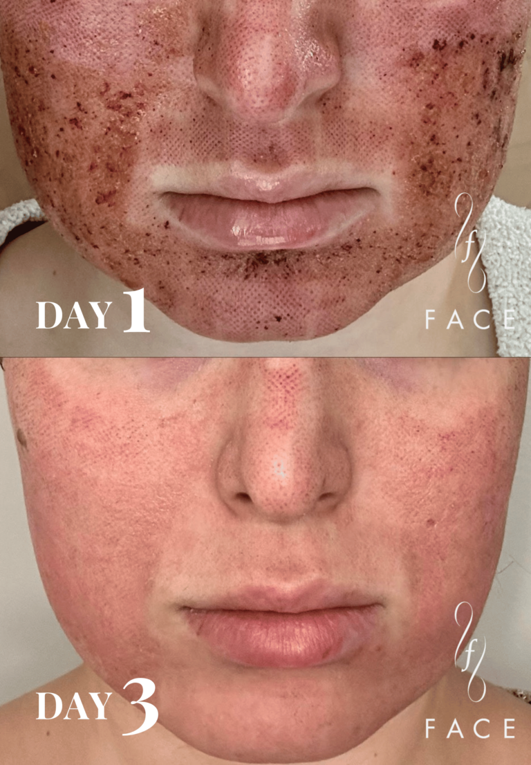 Before and after comparison of Airessence pure PDGF+ Treatment results on facial skin. Day 1 shows skin with visible dark spots and texture, while Day 2 shows significantly clearer, more even-toned complexion demonstrating the treatment's effectiveness.