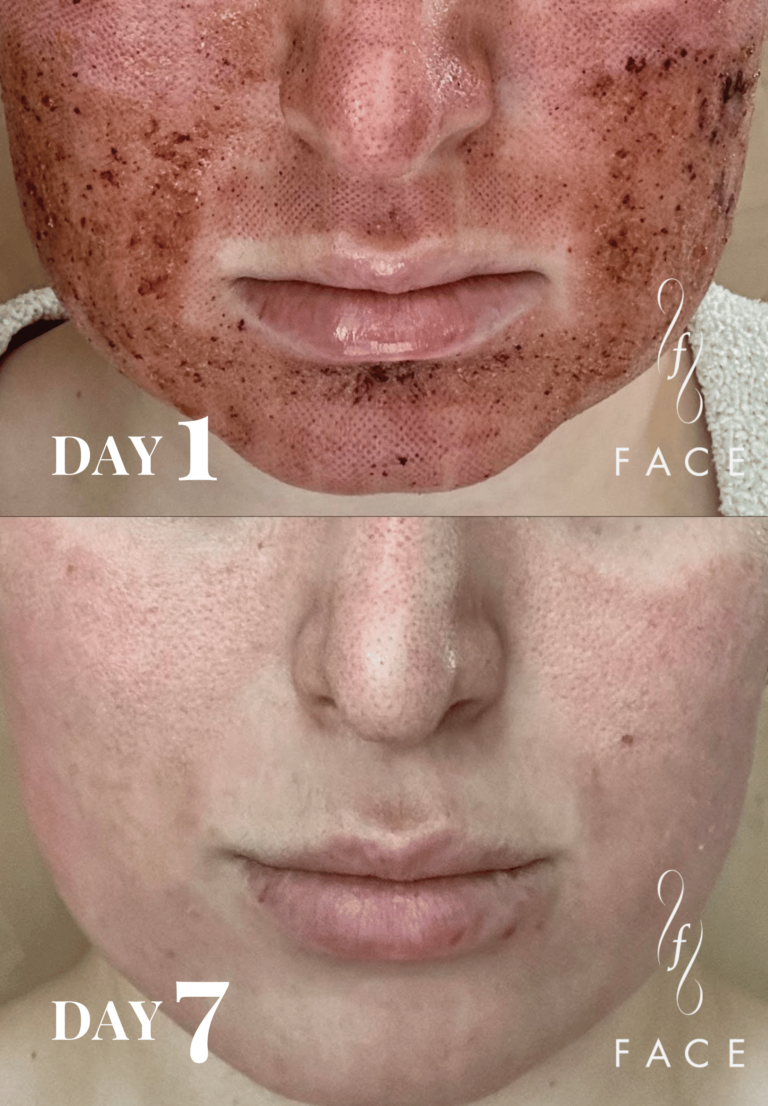 One-week transformation using Airessence pure PDGF+ Treatment: Day 1 shows significant hyperpigmentation and uneven skin texture, Day 7 reveals dramatically clearer, even-toned complexion demonstrating week-long effectiveness.