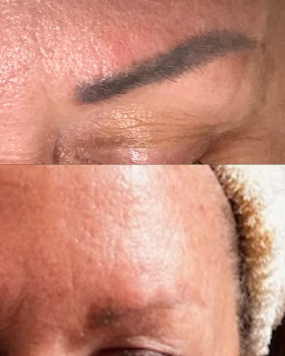 Leslie M - Microblading Removal 2 Session (1)