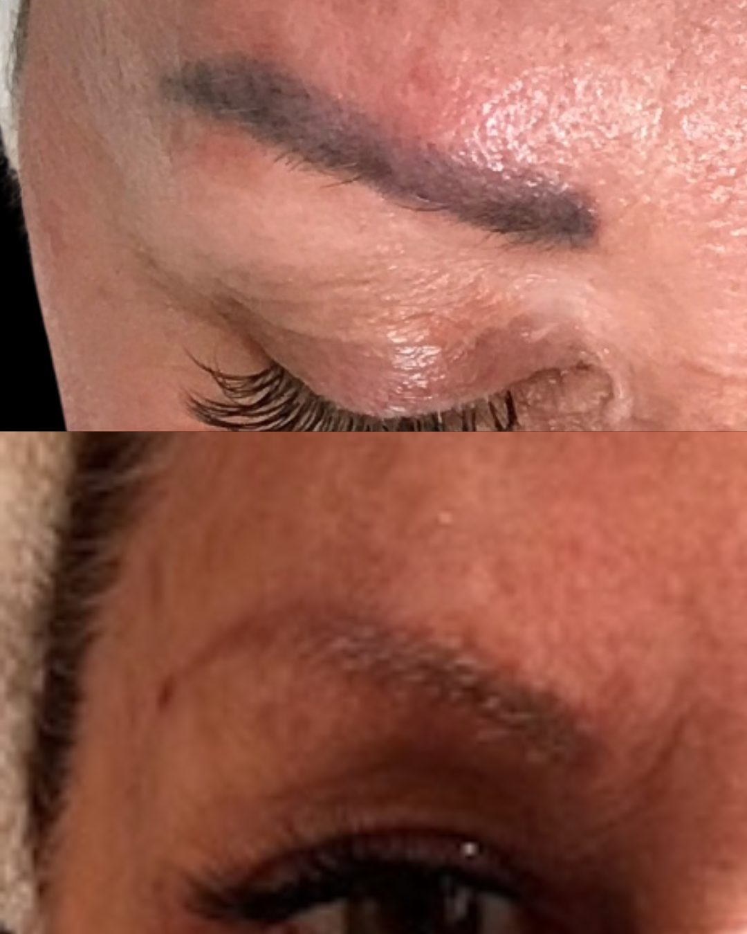 Leslie M - Microblading Removal 2 Session (2)